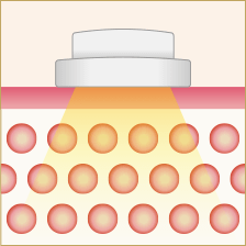 脂肪に超音波を当てて温める